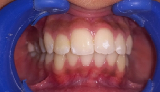 After dental transformation 12