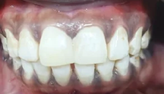 After dental transformation 15