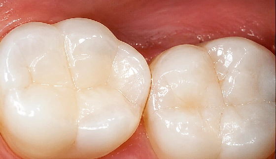 Child Dental Care – after