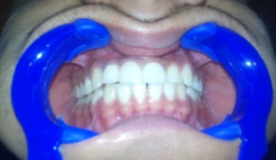 Dental Crowns and Bridges – after