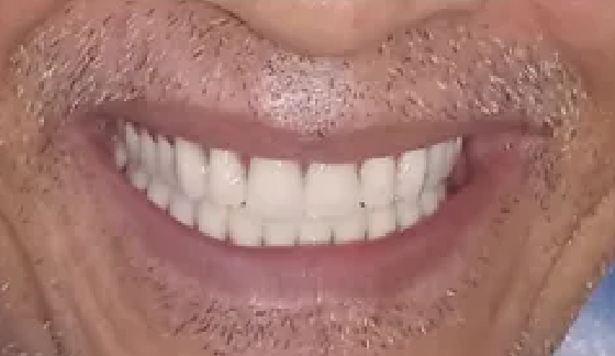 Dentures â€“ after