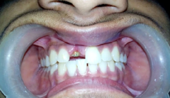 Dental Crowns and Bridges – before