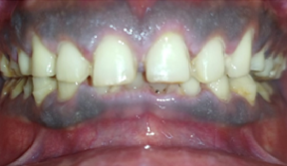 Smile Makeover â€“ before