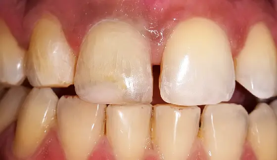 Bleaching / Teeth Whitening â€“ after