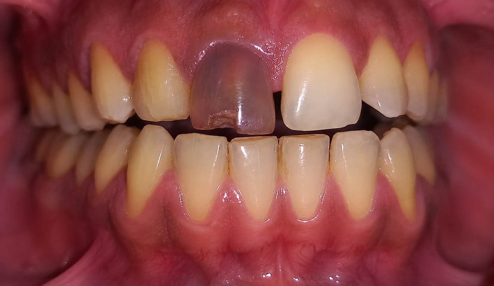 Bleaching / Teeth Whitening â€“ before