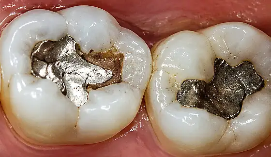 Child Dental Care – before