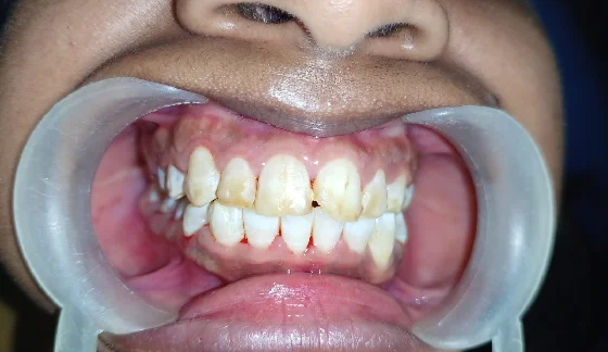 Dental Veneers â€“ before