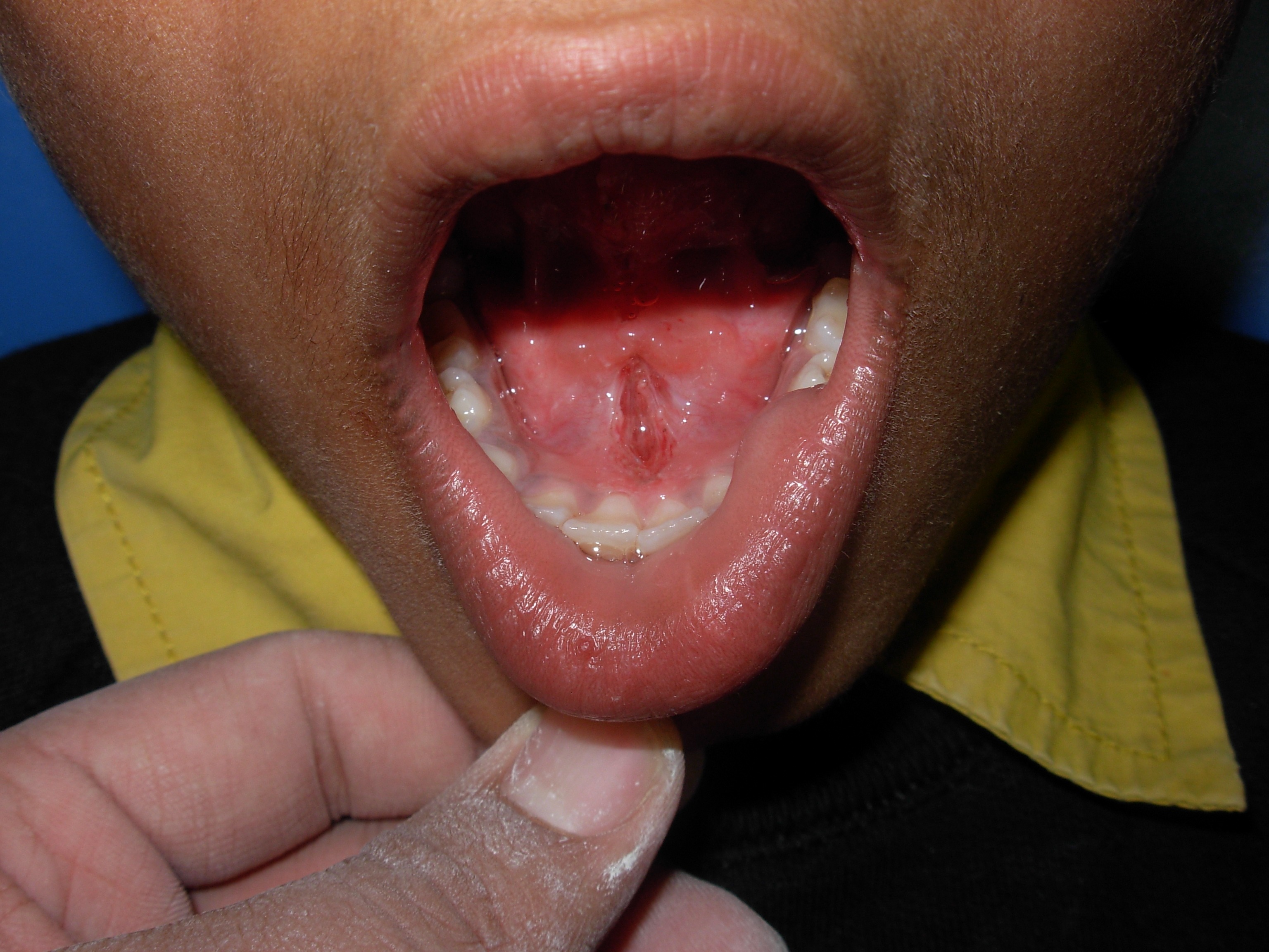 Laser Surgery â€“ after