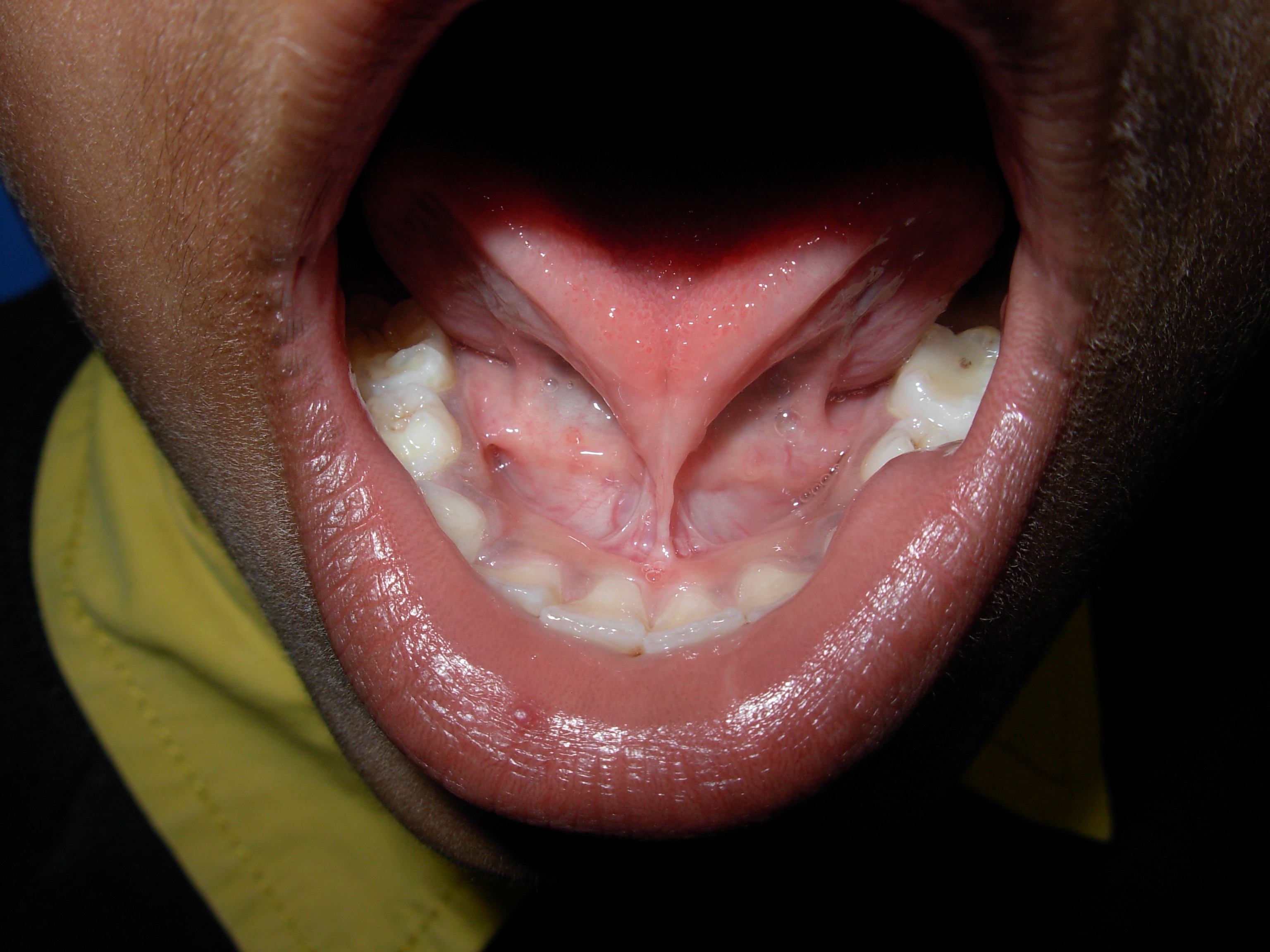 Laser Surgery â€“ before