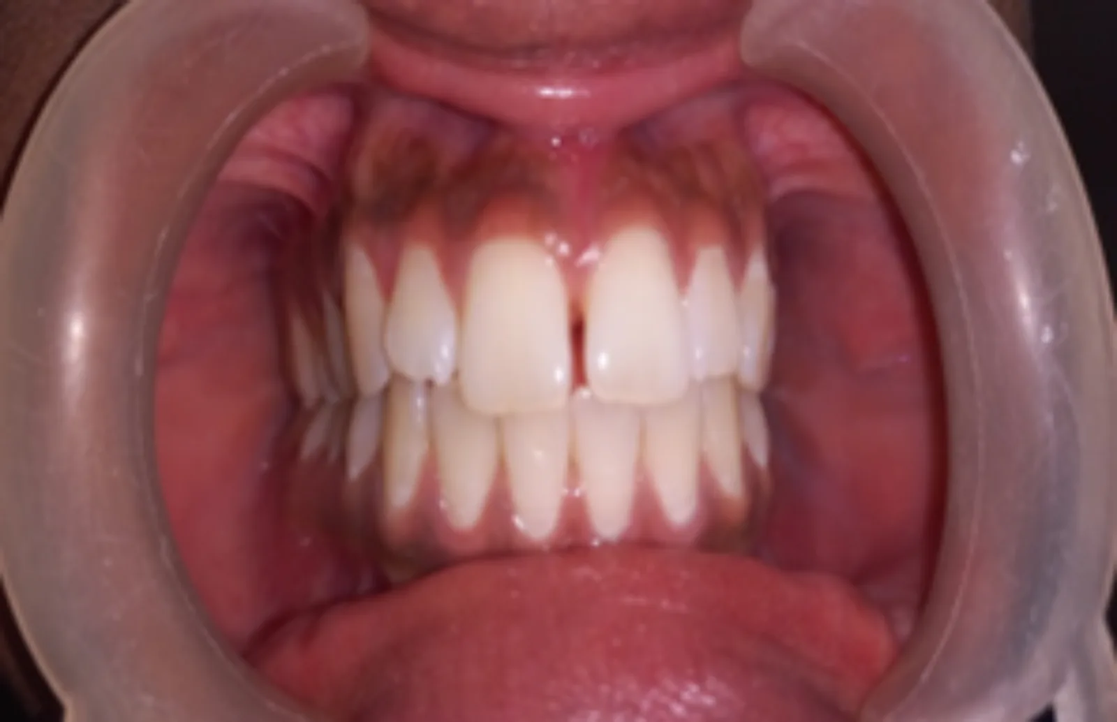 Before dental transformation 1
