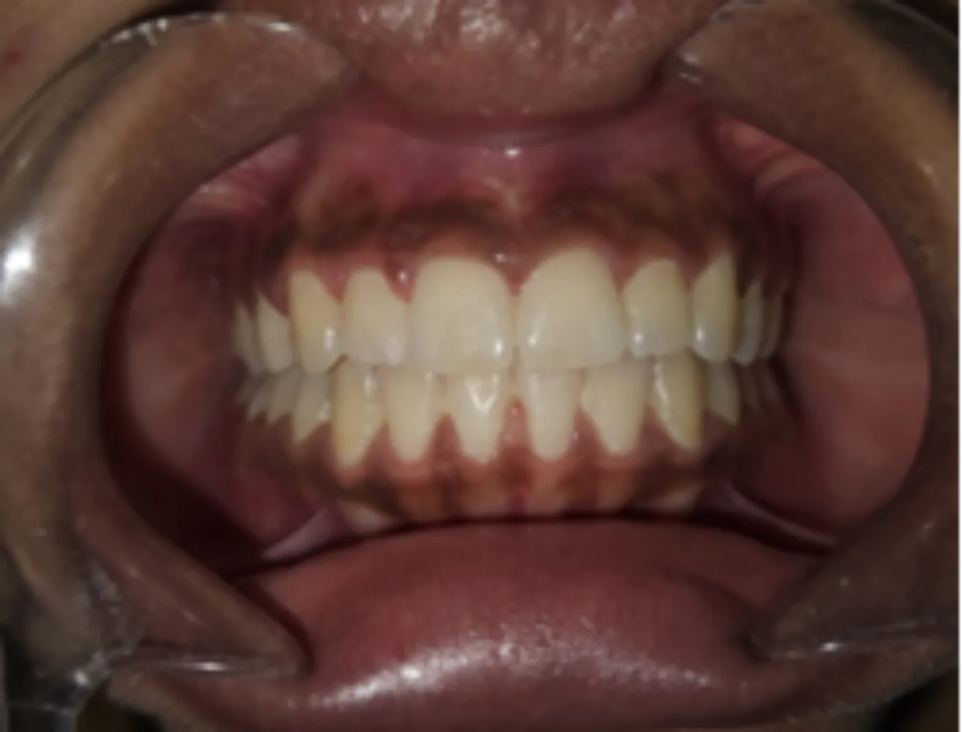 After dental transformation 1