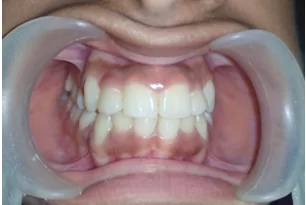 After dental transformation 3