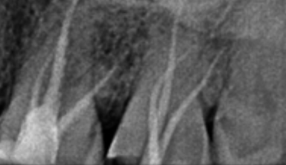 Root Canal Treatment â€“ after