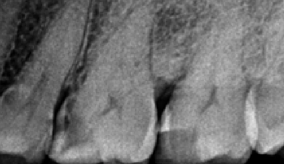 Root Canal Treatment â€“ before
